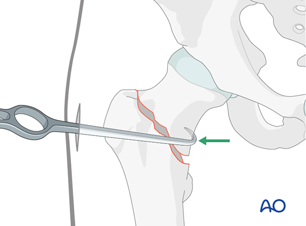 Reduction of a femoral neck fracture with a bone hook