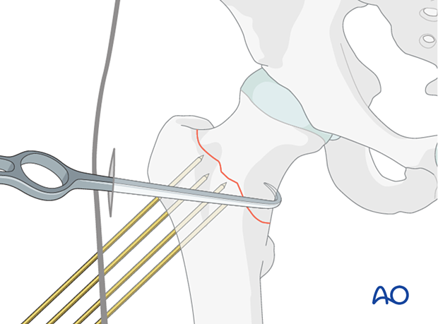 K-wires ready for preliminary stabilization of a reduced femoral neck fracture and a bone hook for countertraction during K-wire insertion