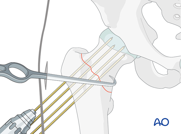 Advancing K-wires for preliminary stabilization of a reduced femoral neck fracture and a bone hook for countertraction the lateral force