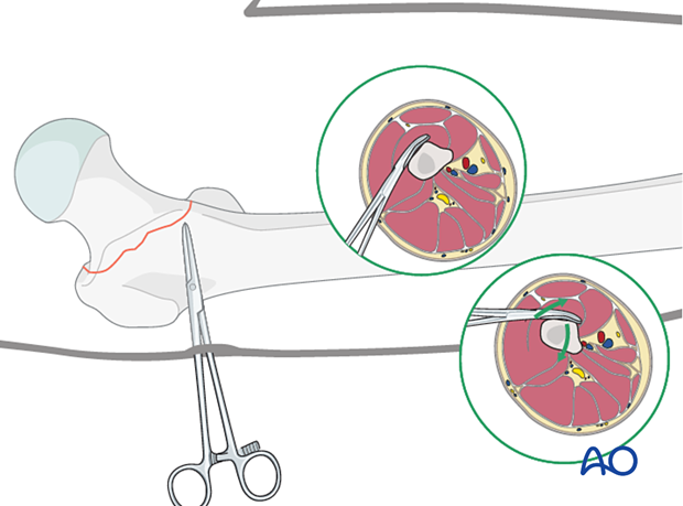 Kelly-clamp reduction of a femoral neck fracture