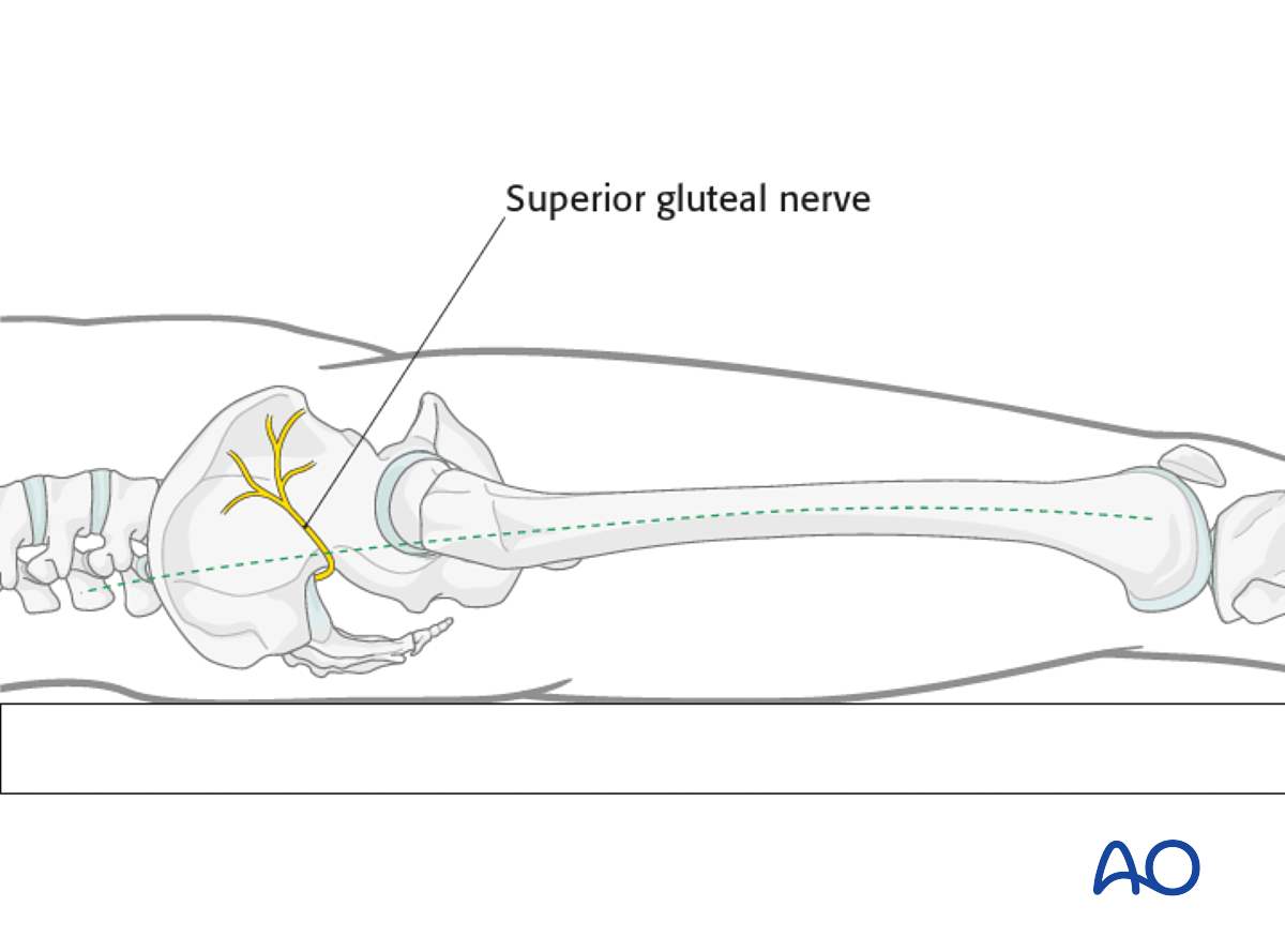 Antegrade Nailing Approach To The Femoral Shaft With Trochanteric Entry ...