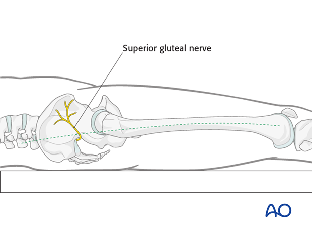 Antegrade nailing femoral shaft – trochanteric entry point