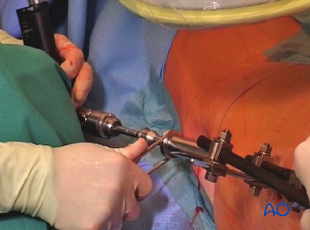 Antegrade nailing femoral shaft – trochanteric entry point – Opening the canal
