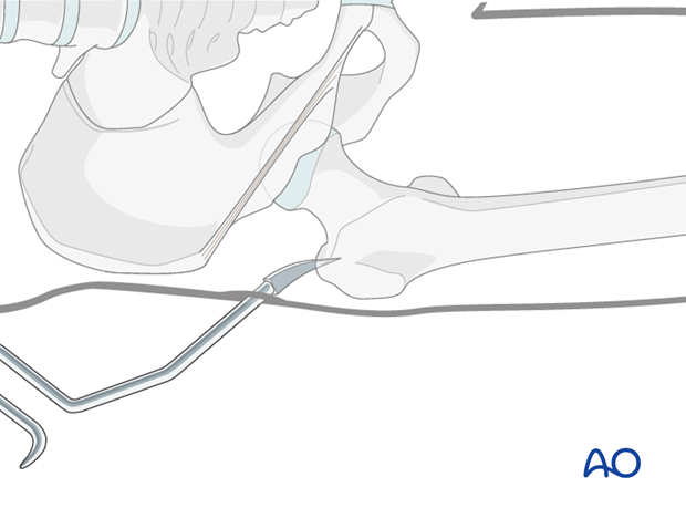 Antegrade nailing femoral shaft – trochanteric entry point – Guide wire