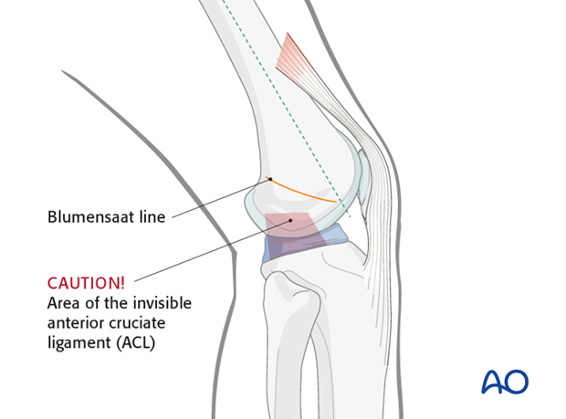 Retrograde nailing femoral shaft – Blumensaat's line