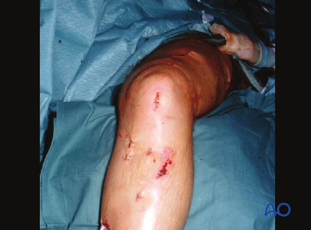 Retrograde nailing femoral shaft – Skin incision