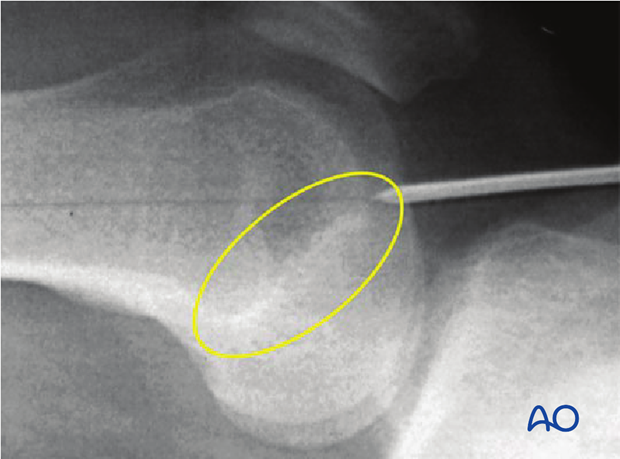Retrograde nailing femoral shaft – Entry point