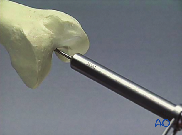 Retrograde nailing femoral shaft – Opening medullary canal