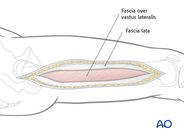 Lateral approach to femoral shaft – Opening the fascia lata