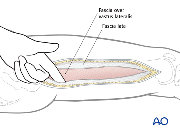 Lateral approach to femoral shaft – Vastus lateralis fascia lata