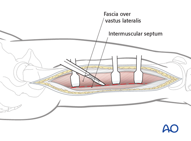 Lateral approach to femoral shaft – Incision fascia vastus lateralis