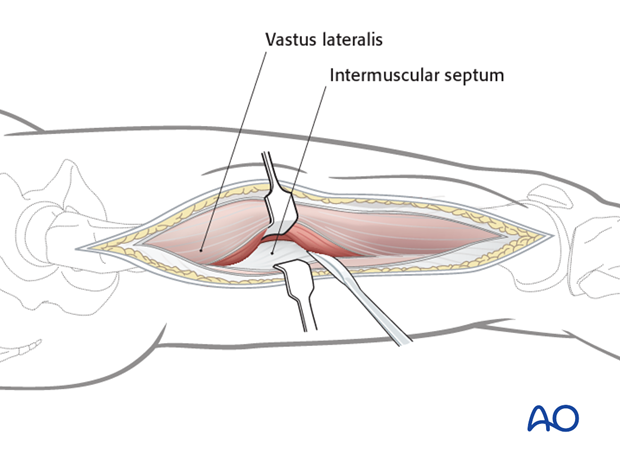 Lateral approach to femoral shaft – Mobilization of vastus lateralis