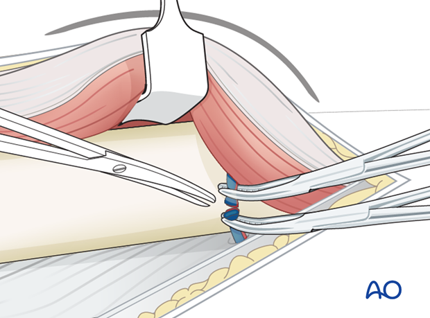 Lateral approach to femoral shaft – Ligation of perforating vessels
