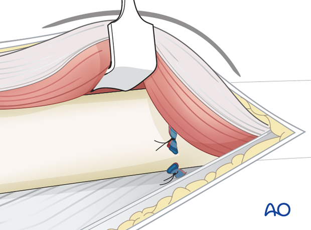Lateral approach to femoral shaft – Ligation of vessel bundles