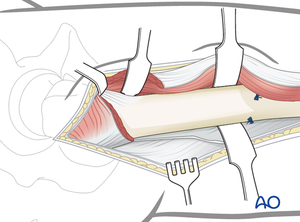 Lateral approach to femoral shaft – Detachment of vastus lateralis