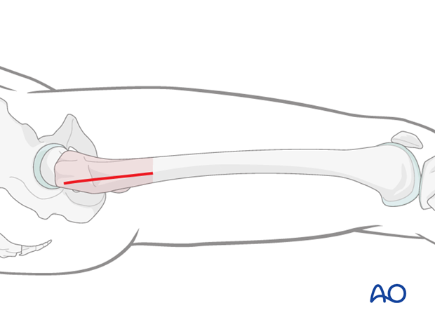 Minimally invasive osteosynthesis – Approach femur – Sub trochanteric - Incision