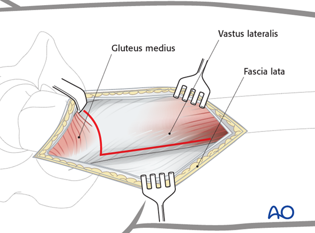 Minimally invasive osteosynthesis – Approach femur – Sub trochanteric - Exposure