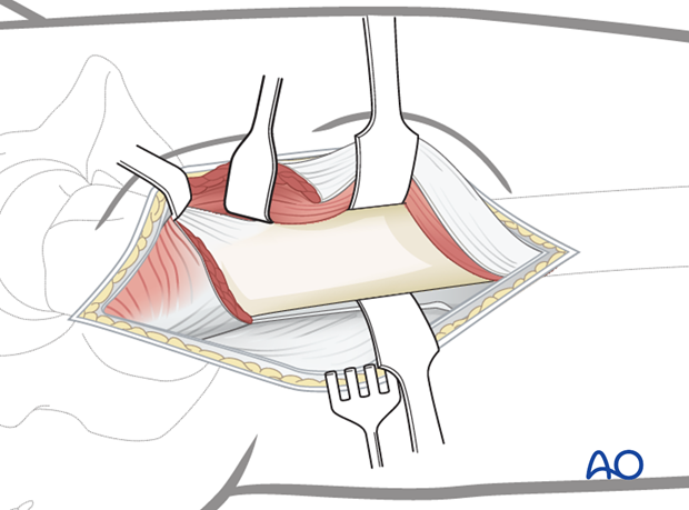 Minimally invasive osteosynthesis – Approach femur – Sub trochanteric - Exposure