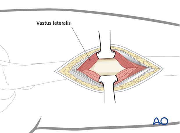 Minimally invasive osteosynthesis – Approach femur – Midshaft - Exposure