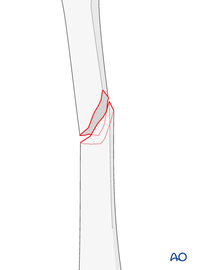 Simple, oblique, proximal 1/3 fractures