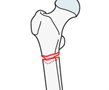 Transverse