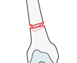 Transverse