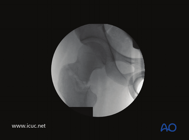 Intraoperative fluoroscopic view of femoral neck fracture with a small amount of traction applied