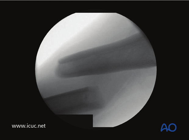 Midshaft fracture in femur, in traction but not reduced