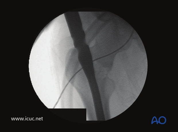 A femoral nail with proximal cephalomedullary locking options is inserted.