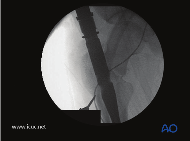 Once the nail is inserted to appropriate length, the femoral neck fracture must be reduced and held with guide wires.