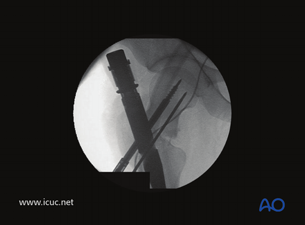 Intraoperative image showing the first screw inserted into the femoral head.