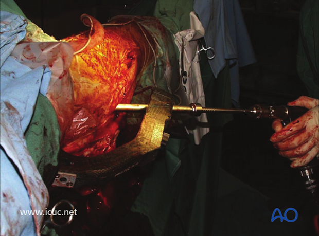 Clinical intraoperative image showing proximal screw insertion into the femoral head using a jig