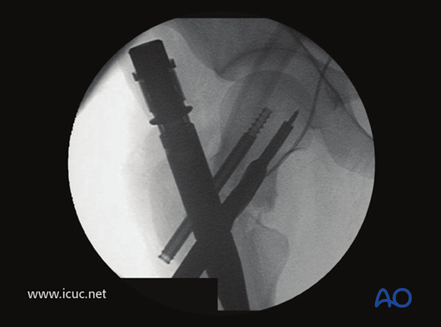 Intraoperative image showing final screw placement