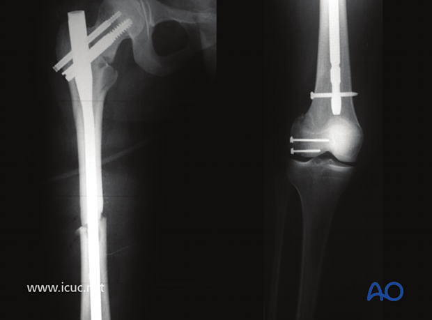 Postoperative images showing complete fixation of the ipsilateral femoral neck, femoral shaft, and distal femur condylar fracture