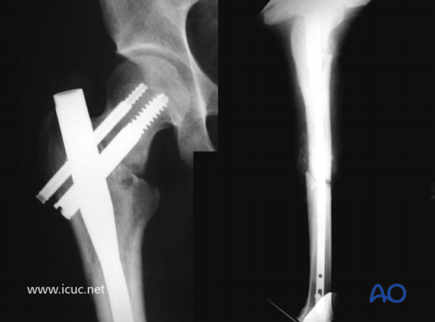 17 weeks postoperative images showing initial femoral neck healing without displacement, but still minimal callus at the midshaft fracture