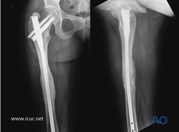 1.5 years postoperative images show that both the femoral neck and shaft fractures are solidly united.