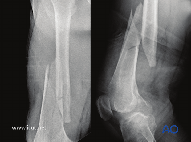 Preoperative X-ray of a closed wedge fracture in the distal third of the proximal femur in a 70-year old male