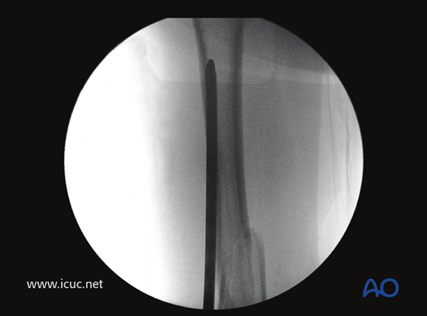 The proximal image shows that the implant is long enough for proximal fixation.