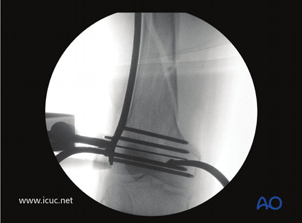 Image showing distal fixation and traction applied such that fracture is reduced and brought to length before proximal fixation is secured.