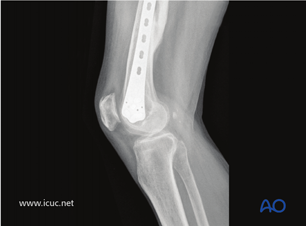 Final images of healed fracture in lateral view at 55 weeks