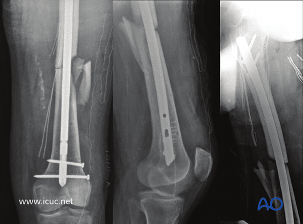 Two weeks later, the patient is stable enough for insertion of a reamed, locked, femoral nail.