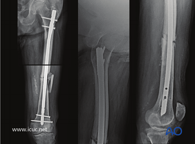 At 24 weeks there is still good fracture alignment, but there is now a gap on the medial side.