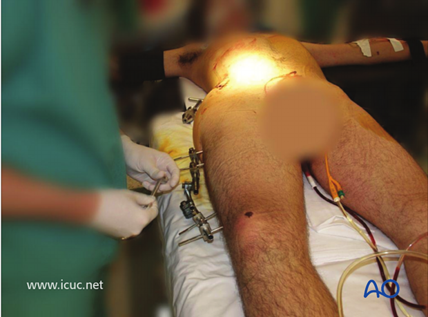 As the patient is now stable for definitive fixation of the femoral shaft, the external fixation is being removed.