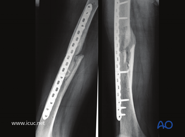 14 weeks postoperative AP and lateral image showing exuberant callus evident