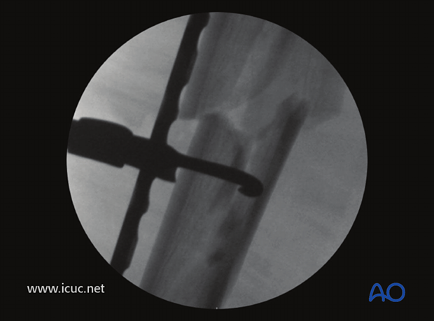 Fluoroscopic imaging is used to guide reduction before plate fixation with locking head screws.
