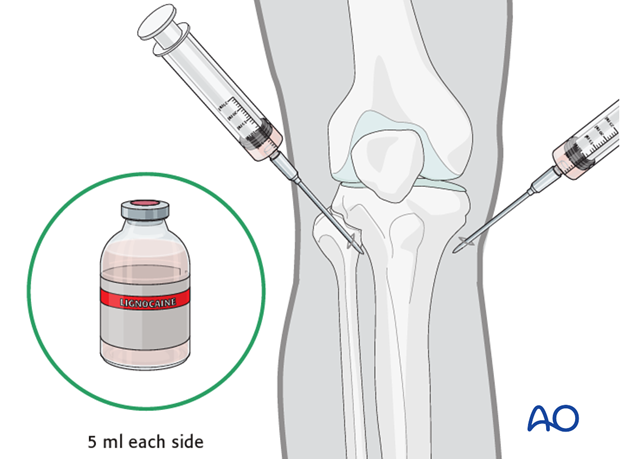 proximal femur fracture management with minimal resources