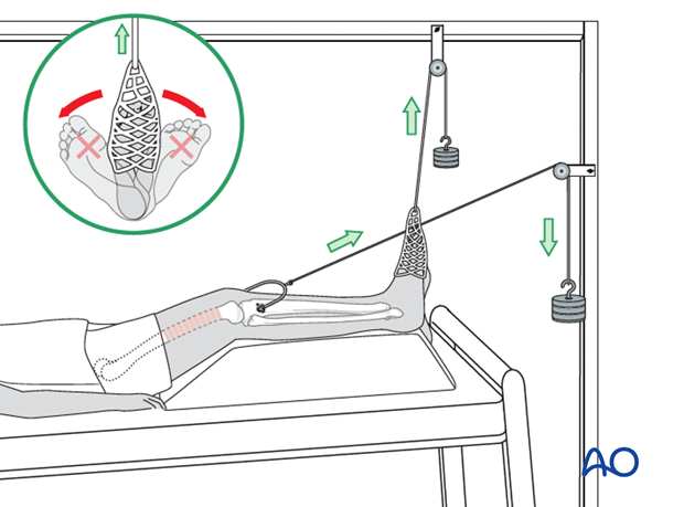 Application of adhesive sock to maintain rotation and dorsiflexion in the ankle