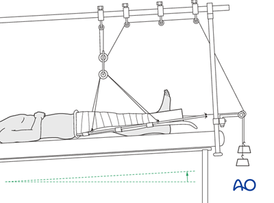 Temporary Thomas splint for Simple, spiral, proximal 1/3 fractures