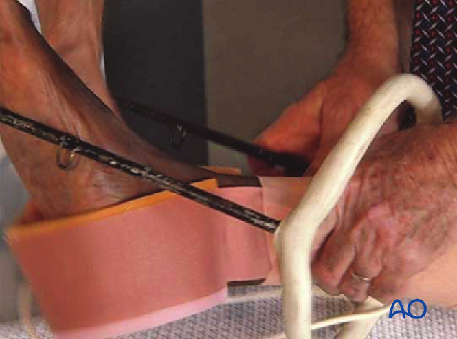 Tsf Splint Temporary Thomas splint for Simple, transverse, middle 1/3 fractures