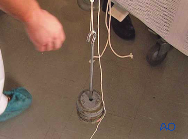 T-pulley installation for Thomas's splint